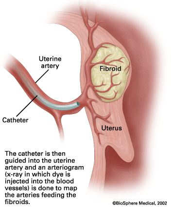uterine fibroids essay uterine fibroids essay